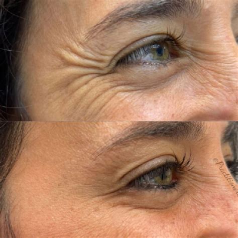 crows feet wrinkles treatment